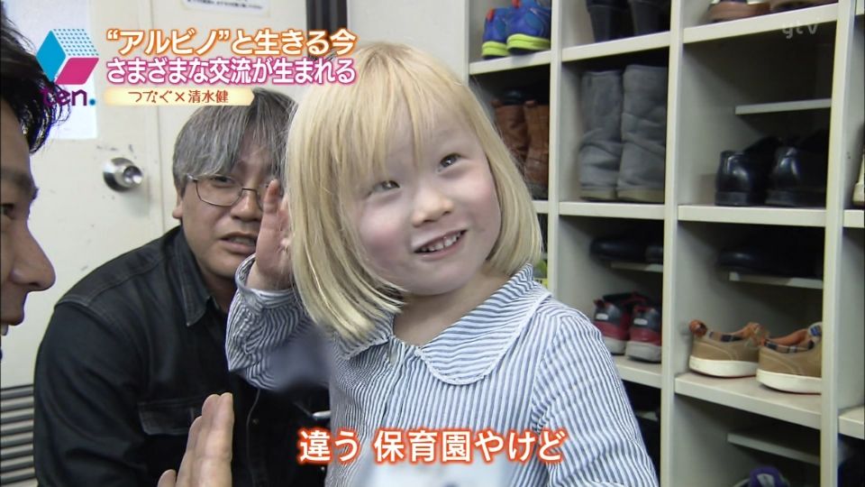 アルビノの日本人&モデル20人まとめ!人間と動物の画像あり