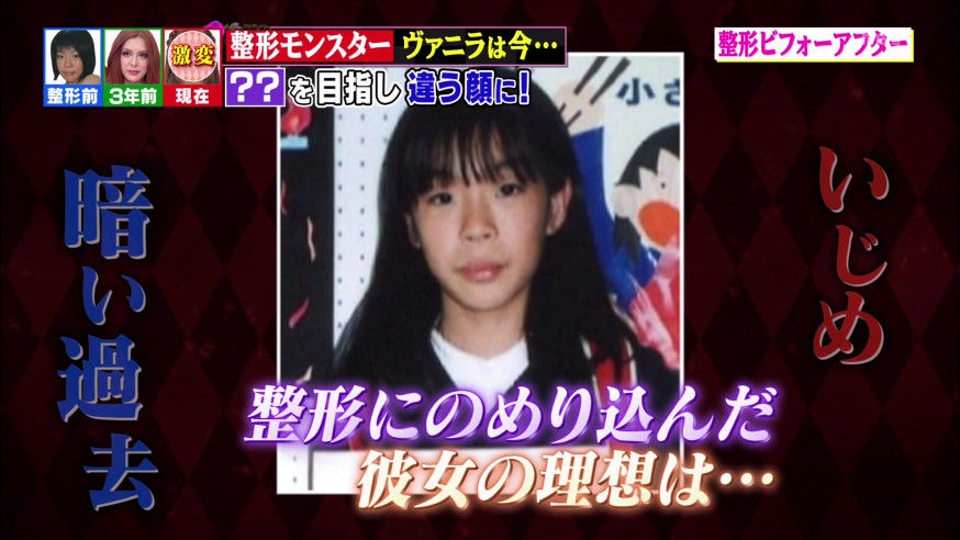 ヴァニラ整形前と現在!本名と年齢・元の顔からの変化まとめ【画像あり】